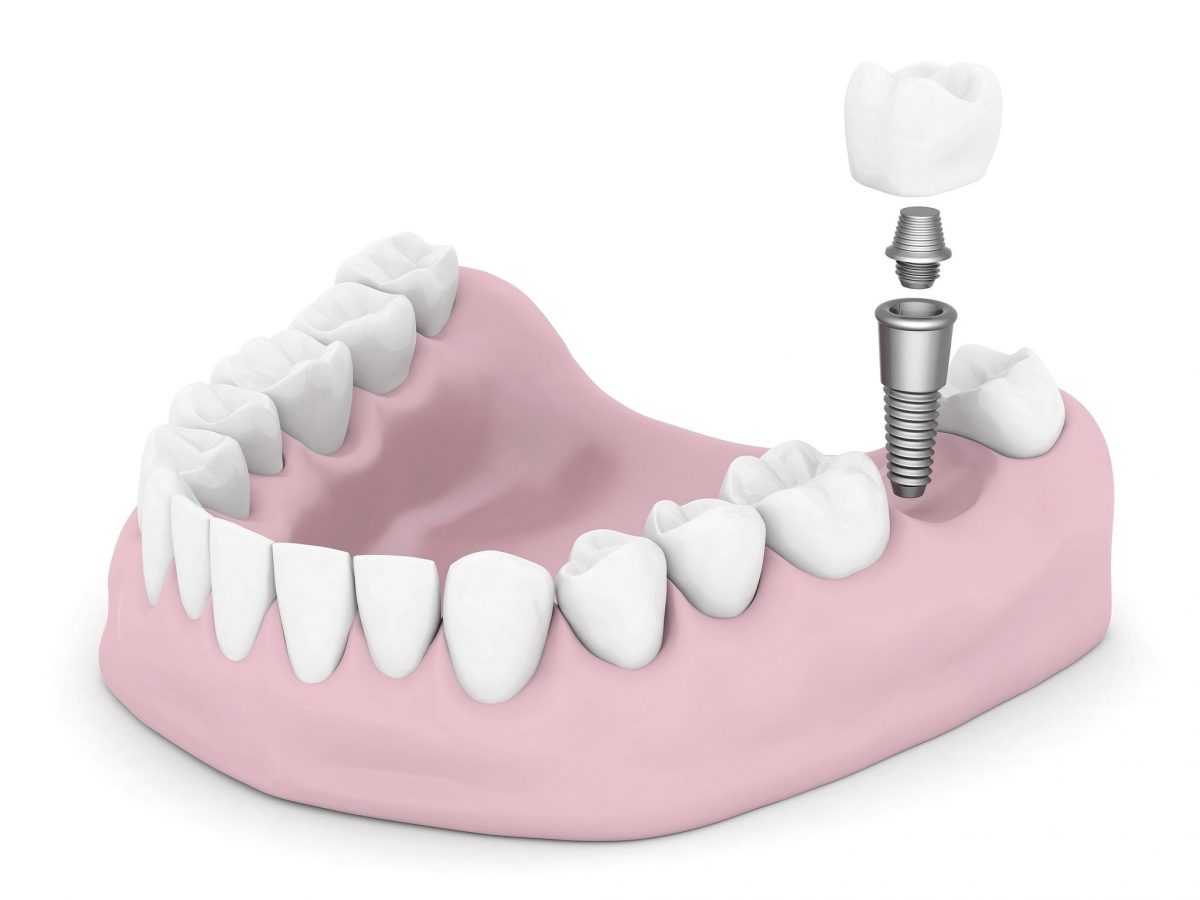 Why Dental Implants Are the Best Option for Replacing Missing Teeth