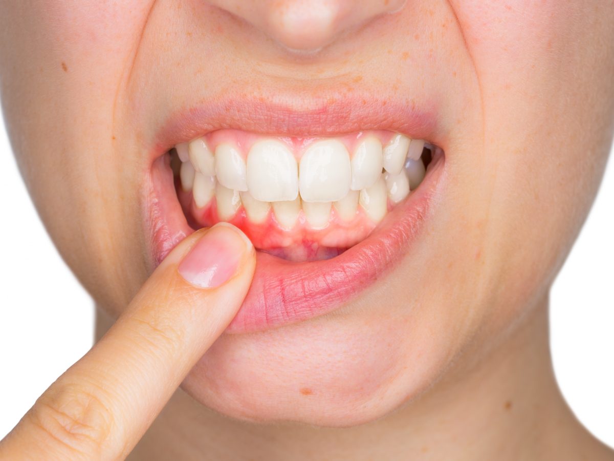 3 Key Things You Need To Know About Gum Recession