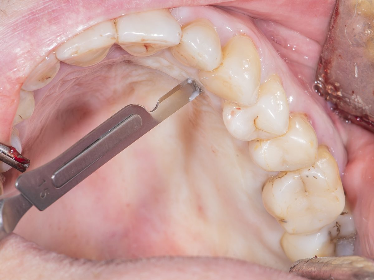 Top Reasons Why A Bone Graft May Be Needed Before the Placement of Dental Implants