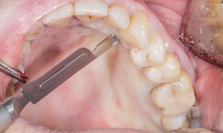 Top Reasons Why A Bone Graft May Be Needed Before the Placement of Dental Implants